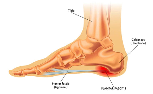 Plantar Fasciitis – Causes and Cures | Enertor Medical